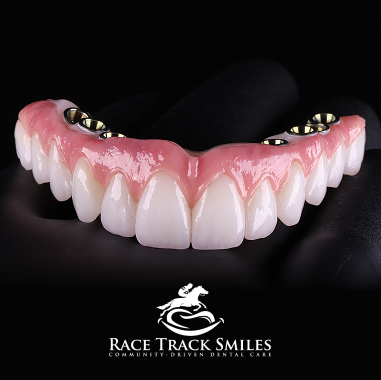 Hybrid Implant Bridge