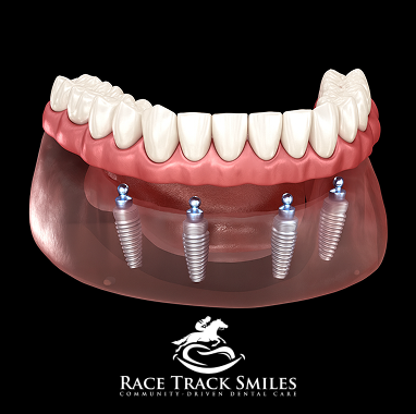 Zirconia Implant Bridge