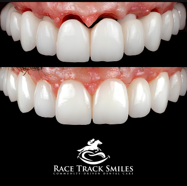 Porcelain Implant Bridge